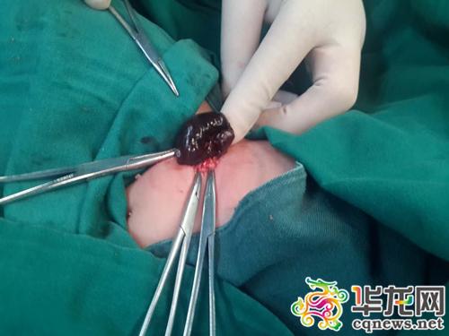 5个月大女童腹股沟长了一个包 切开一看竟是卵巢
