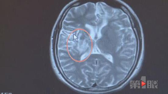 重庆一女子脑袋里长了四年虫子 被活捉出来