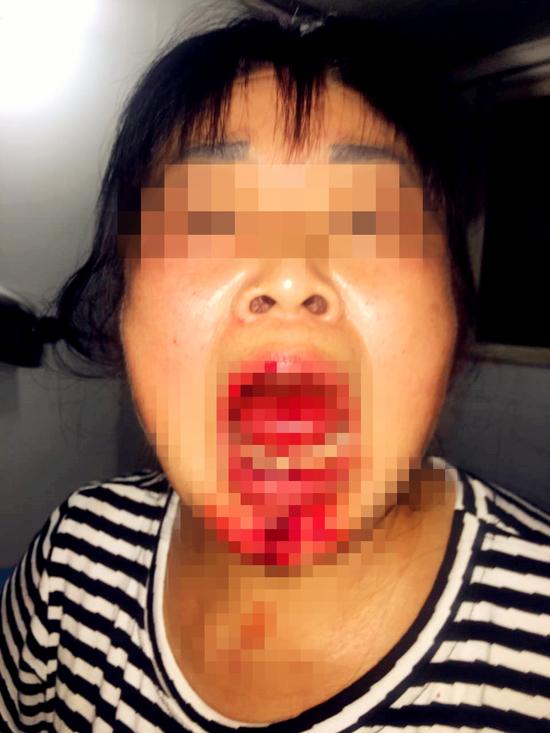 小丽母亲的伤情,看得人触目惊心