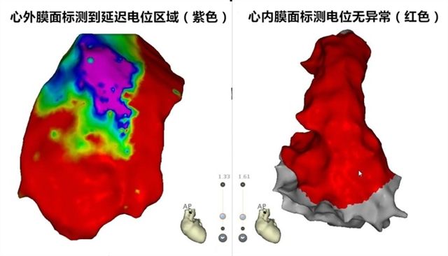 图2 右室流出道心外膜面和心内膜面电位分布图,红色为正常电位区域,紫色为延迟电位区域。