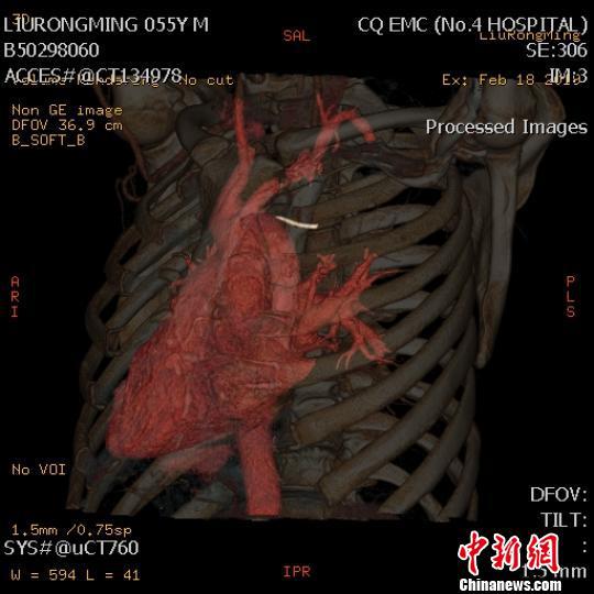 图为刘某检查时的三维成像图。 重庆急救中心供图