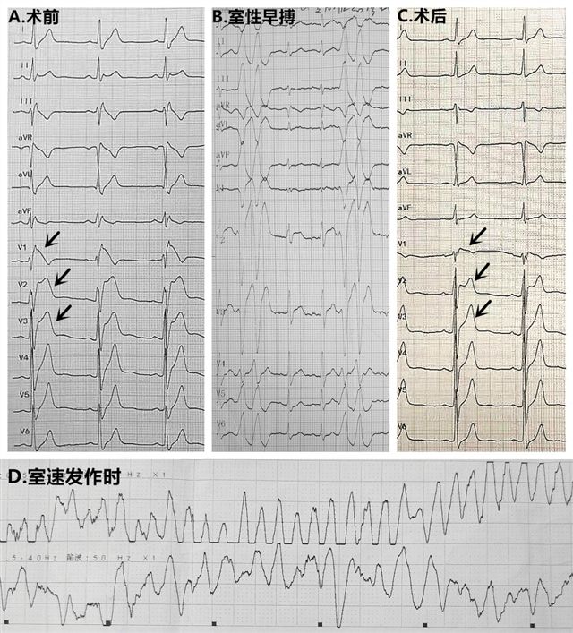 图1 A。术前V1-V3导联Brugada波非常明显(箭头所示);B。频发右室流出道起源的室性早搏;C。术后Brugada波显著减小(箭头所示;)D。患者意识丧失时心电监护记录到室速。