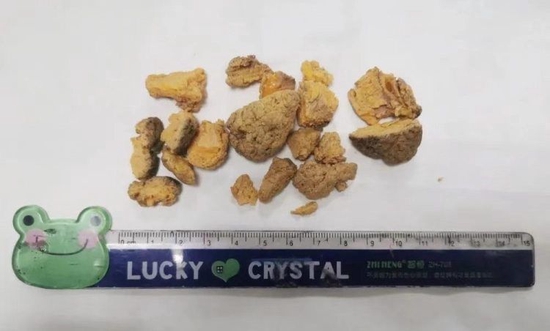 ▲医生从晶晶胃里取出的已经被裂解的结石