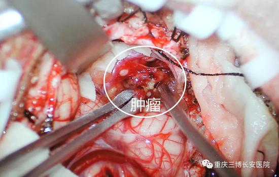 小感冒竟演变成脑肿瘤!
