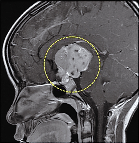 亮亮大脑"脑核"的鞍区位置有一1.5厘米大小的错构瘤.