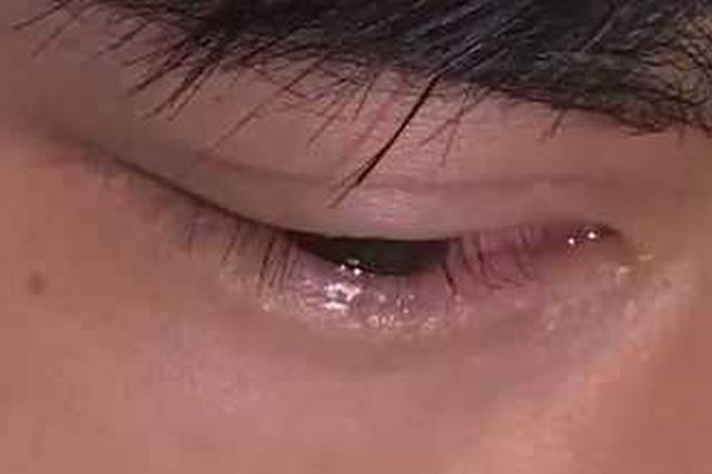 男子玩"雪花喷雾"伤眼 角膜被烧伤脱落