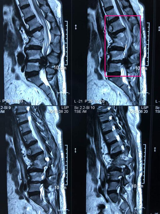 术前MRI
