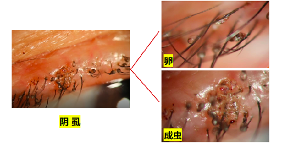 眼睛奇痒无比，可能是阴虱爬满睫毛