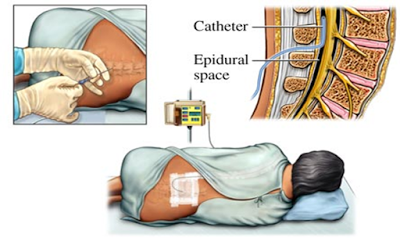 庆安琪儿妇产医院解秘欧美最流行的无痛分娩还