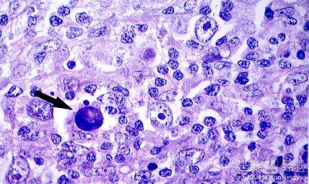 淋巴瘤gdp_淋巴瘤早期症状图图片