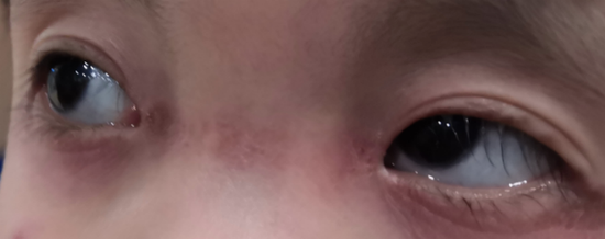 欣欣手术前的双眼
