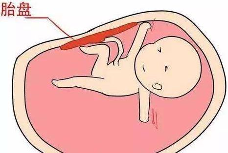 胎盘早剥 注定要让孕妈遭受一场劫难