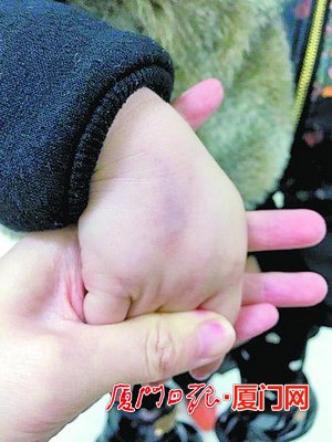 2岁女童被误注射抗生素。(女孩家长供图)