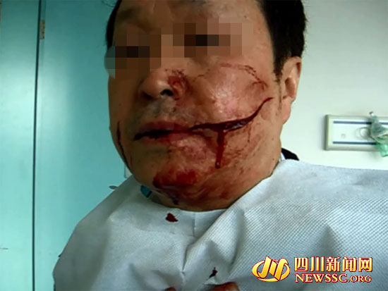 六旬老人公交制止扒手被割脸