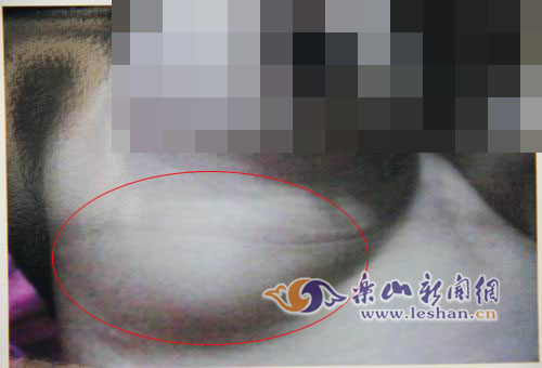 女子出示的隆胸假体拍图