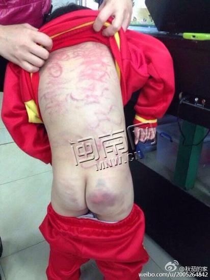 微博上流传的小女孩受伤图