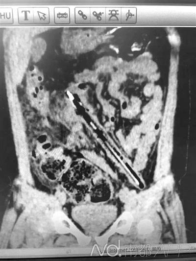 7岁男孩将15厘米长笔塞进肛门 1个月后才取出