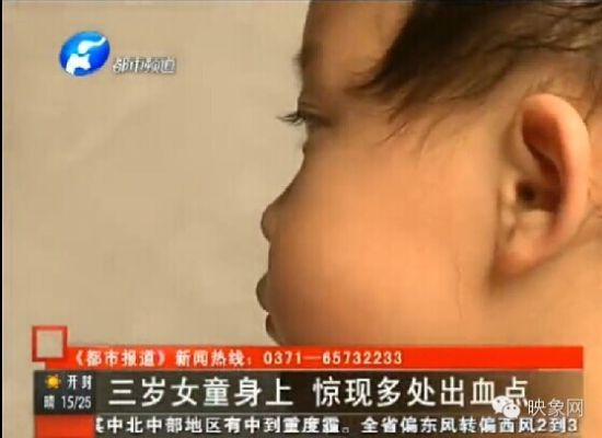 3岁女童疑被幼师全身扎针 出现肾衰竭(图)