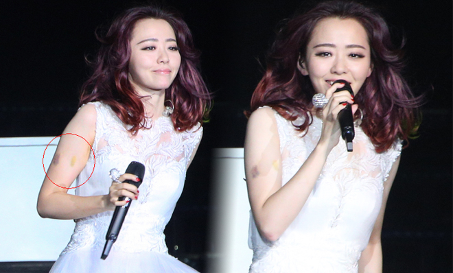 张靓颖演唱会摔下舞台 再次登台疑瘀伤严重