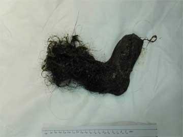 【14岁异食癖女孩吃头发解忧 胃里形成毛发. 来