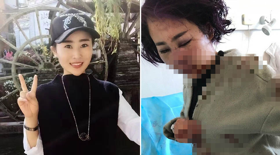女子自称在丽江遭围殴毁容