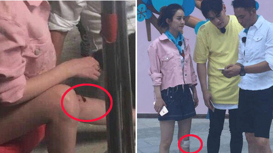 赵丽颖受伤怎么回事?赵丽颖是怎么受伤的 赵丽颖受伤严重吗?