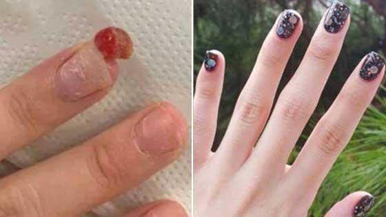 孕妇手指长肉瘤化脓险被截肢 竟是美甲惹的祸