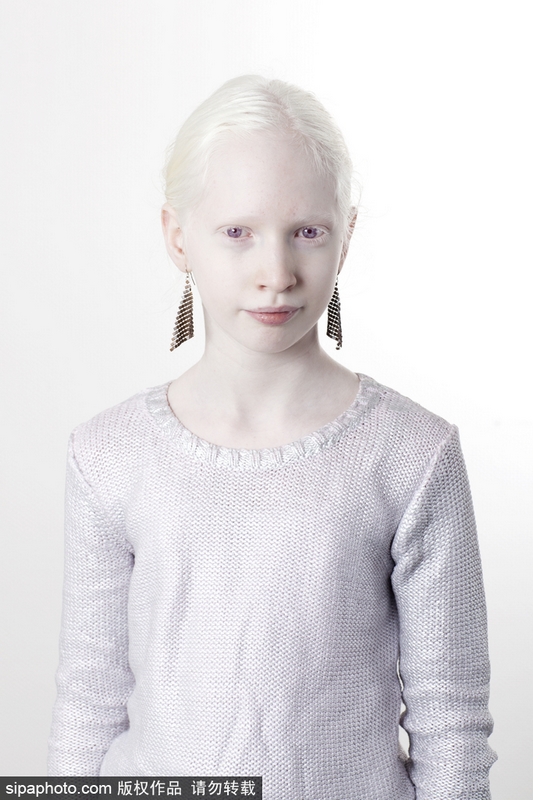 摄影师记录白化病人肖像仿若"天使"