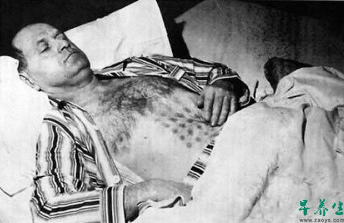 7 在1967年5月20日,Stefan Michalak 在加拿大曼尼托巴省的猎鹰湖附近散步时看到了两个雪茄状的UFO。其中一个飞船打开了门,Stefan听到了一些声音,并试图与里面的生物交流。他靠近飞船,但是却无法分辨里面的东西是什么。突然,飞船的大门紧闭并且开始上升,并向他喷出让他的衬衫燃烧的热气,留下了这些网格状的烧伤痕迹。