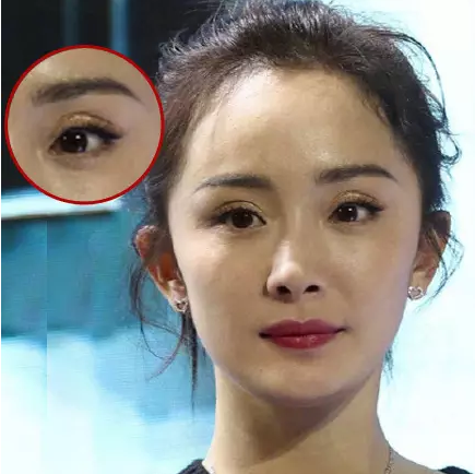 看看她前段时间的双眼皮贴。