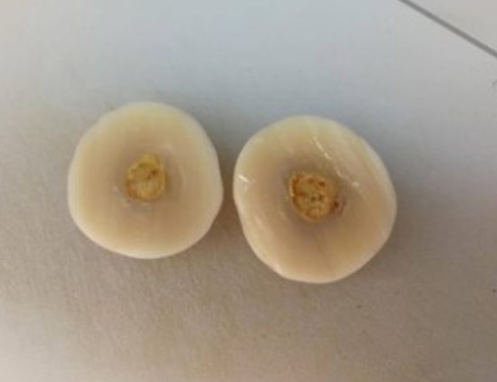 体内取出的“蛋”