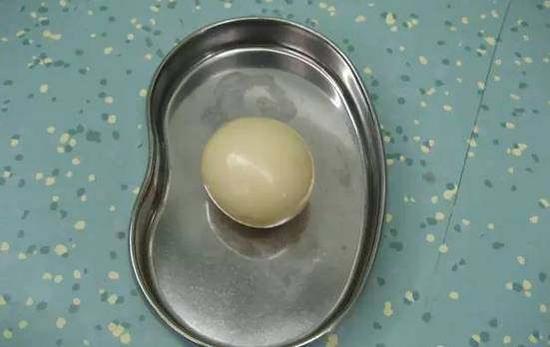 CT检查显示,他的腹腔有一个肿块。医生分析有可能是小肠肿瘤,建议曹先生接受手术切除。然而,当医生打开患者腹腔,定位到“肿块”的位置,正准备伸手取出它时,发生的一幕让在场的医生目瞪口呆。