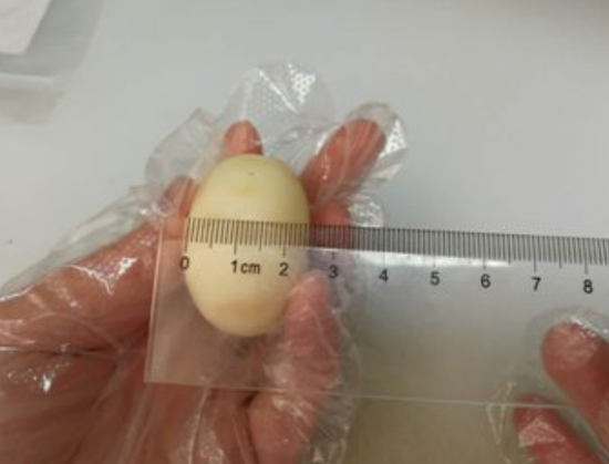 手术后,大家仔细观察,取出物竟颇似