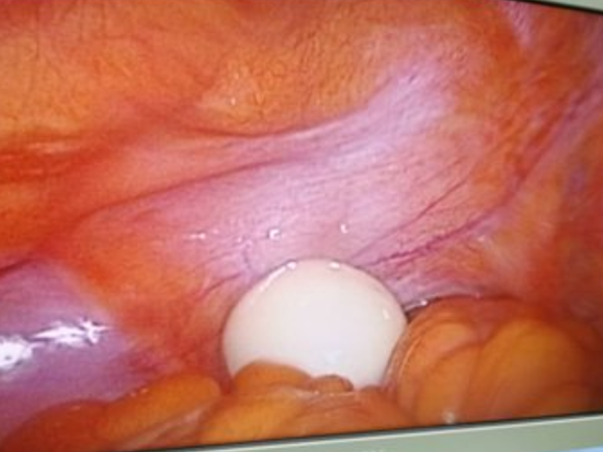 11 月 1 日,王先生因右下腹部疼痛往秦皇岛市中医医院就诊,经查腹部 CT 后发现,其右下腹腔内有一个椭圆形的软组织团块影,初步考虑为腹腔内游离体。