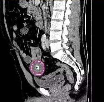 此前,家住扬州市区的曹先生腹痛,到医院检查,发现体内有个圆形肿物。手术时,医生从他腹腔内居然取出了一个圆润光滑、颜色淡白的“蛋”,就连医生都惊呆了。