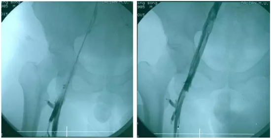 年轻人也要警惕下肢静脉血栓