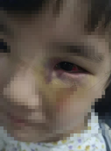 青云谱区教体局工作人员证实，网传照片中女孩眼部受伤，系其老师所致。