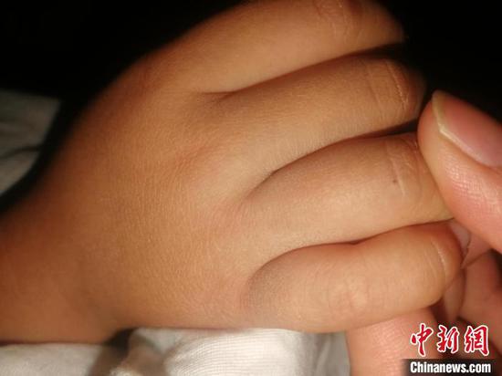 图为赵女士女儿手上的疑似针眼。赵女士供图