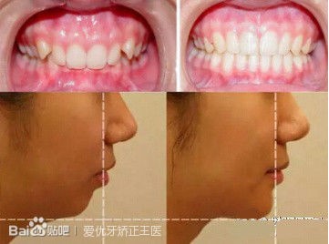 引起露龈微笑的原因有软硬组织两方面因素:上唇过短和上颌牙槽骨过高.