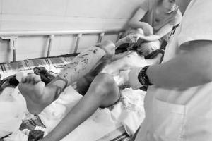 医生正在为身体多处烧伤的杨同学换药 家属供图