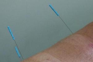 美国中医界争取针灸入医保 赵美心提案待民众签名