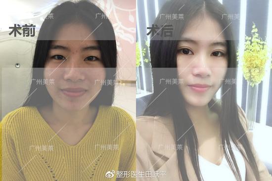 肿眼泡适合割双眼皮吗