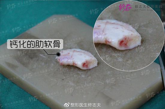 肋软骨钙化了怎么回事 要怎么做鼻综合整形