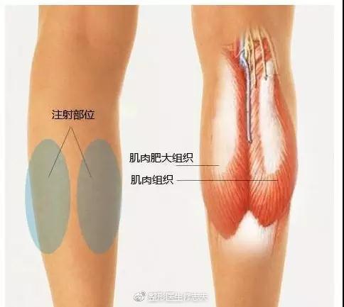 拿什么来拯救你们的肌肉小腿