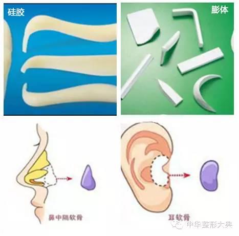 隆鼻材料