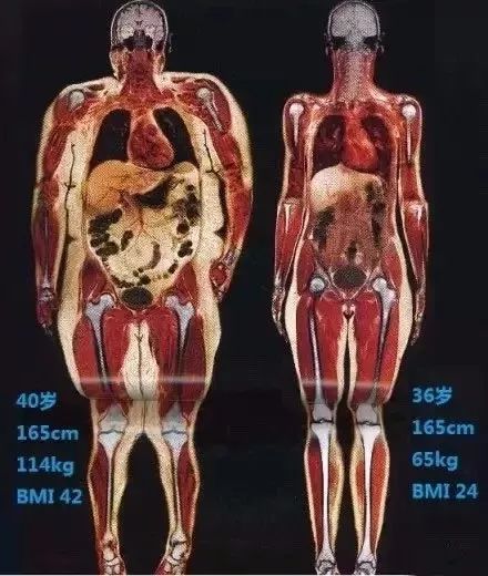 肥胖者肝脏脂肪与正常人对比