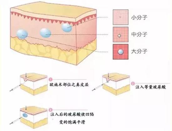玻尿酸的原理是什么_玻尿酸的原理(2)