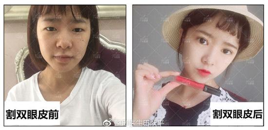 肿眼泡适合割双眼皮吗