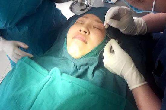 双眼皮手术过程是怎样的?|双眼皮手术|双眼皮|