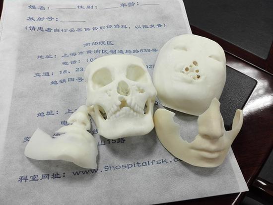  术前用3D打印技术还原模拟患者残缺的面部，并制定手术方案。上海第九人民医院 供图